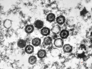 M,10y. | herpes virus - herpetic encephalitis M,10y. | herpes virus - herpetic encephalitis